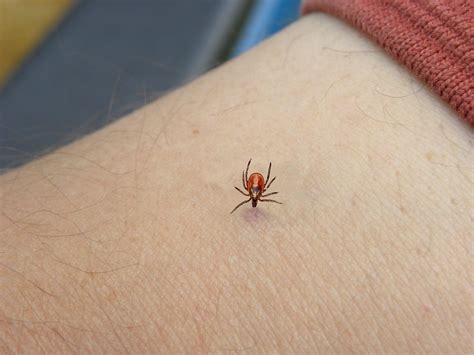 Tick Removal From Humans