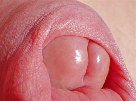 Lick Inside My Foreskin Taste My Moist Glans 1 Pics Xhamster
