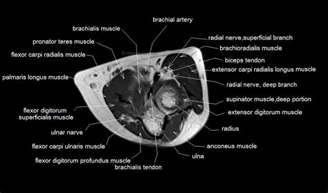 Radiology department of the rijnland hospital, leiderdorp and anterior graphic of the shoulder. mri anatomy of elbow | axial cross sectional anatomy of elbow joint