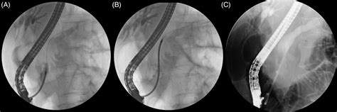Soehendra Stent Retriever For Dilation Of Tight Biliary And Pancreatic