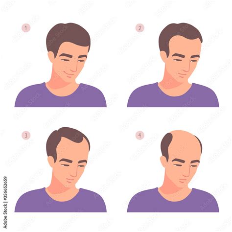 Stages Of Baldness Progress Hair Loss Process Portrait Of A Man