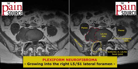 Plexiform Neurofibroma Lumbar Spine The Pain Source Makes
