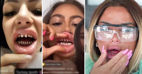 Dentist Warns Teeth Shaving Teens Theyll Need Dentures By Their 40s