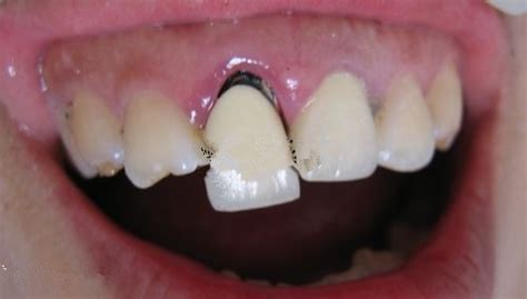 根管治療之後，醫生說帶牙套牙齒會發黑，有什麼影響嗎？ 壹讀