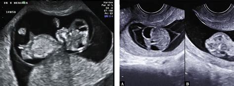 Figure 4 From Acrania Exencephaly Anencephaly Sequence Phenotypic Characterization Using Two