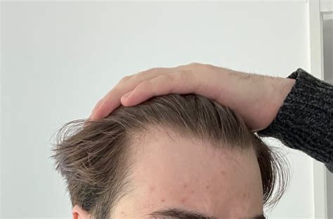 Is This A Mature Hairline Or Balding Should I Be Worried 24m R