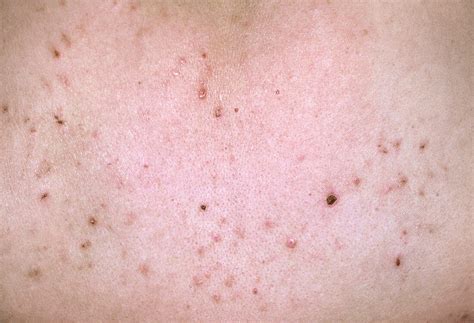 Pityriasis Lichenoides Spots On Skin Bild Kaufen 12068050 Science