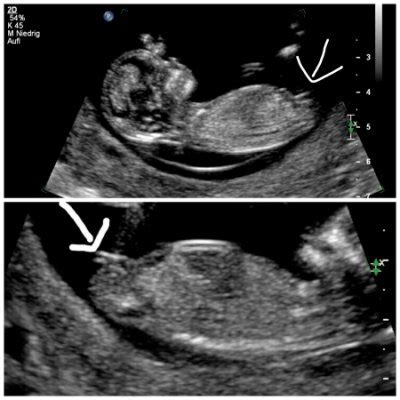 Ultraschall Bilder 2.0 - Juni 2017 BabyClub - Seite 59 ...