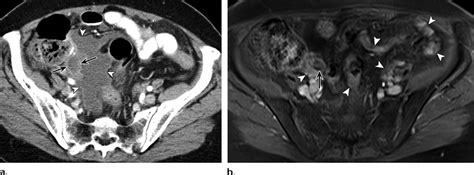 Lamn And Pmp In A 68 Year Old Woman A Axial Ct Image With