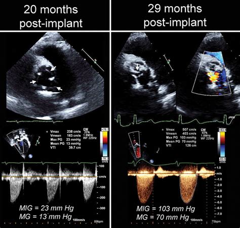 Accelerated Degeneration Of A Bovine Pericardial Bioprosthetic Aortic