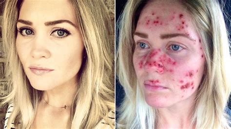 Woman S Skin Cancer Selfies Go Viral — And Inspire Skin Checks Allure
