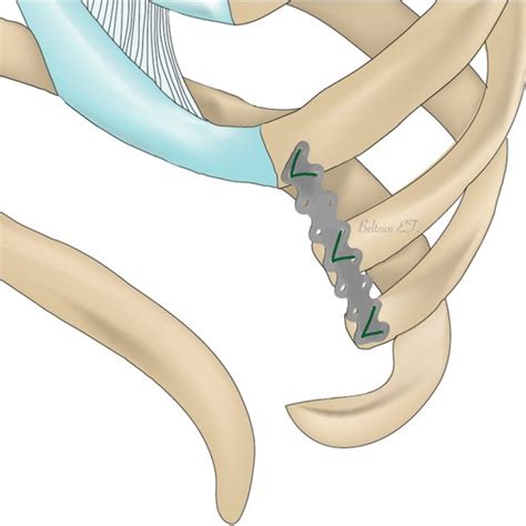 An Illustration Of The Surgical Approach For The Treatment Of Recurrent