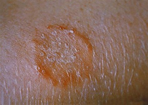Different Types Of Ringworm And How They Affect Humans