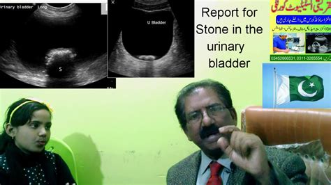 Report For Stone In The Urinary Bladder Youtube