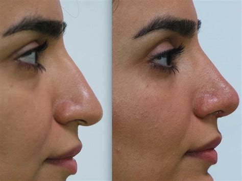 All You Need To Know Before Getting A Nose Job Lifestyle Gulf News