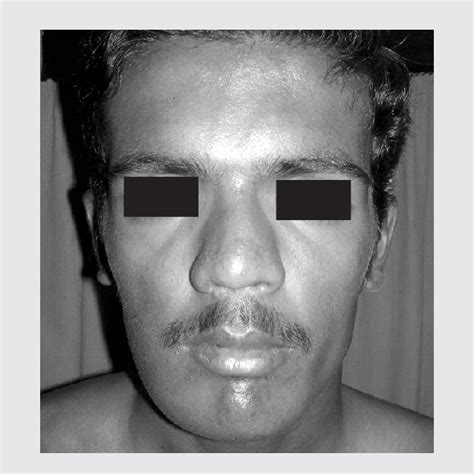 Pdf Bifid Rib Jaw Cyst Basal Cell Nevus Syndrome A Case Report