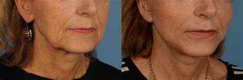 facelift neck lift before and after pictures case 145 toronto on ford plastic surgery dr