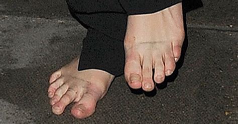 Celebrities With Bunions Surgery 28 Celebs With Ugly
