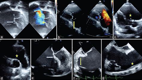 Role Of Imaging In The Diagnosis Of Arrhythmogenic Right Ventricular