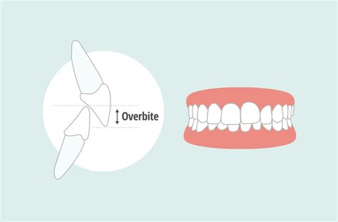 Underbite Vs Overbite What’s The Difference And How Are They Treated Hawley Orthodontics