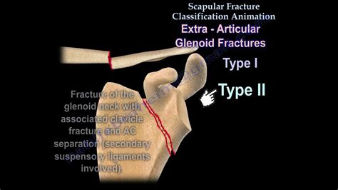 Scapular Fracture Classification Animation Everything You Need To
