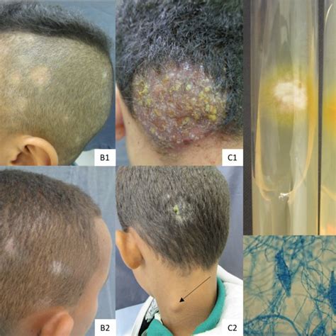 Tinea Capitis Clinical Forms Alopecic Microsporosis A1 And A2