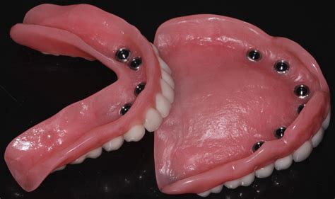 Glidewell Inclusive Mini Dental Implant Dentures Denture Implants