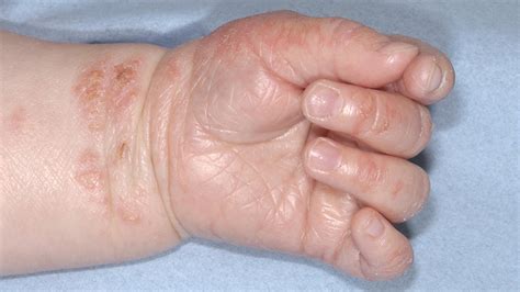 Eczema En Bebés Babycenter