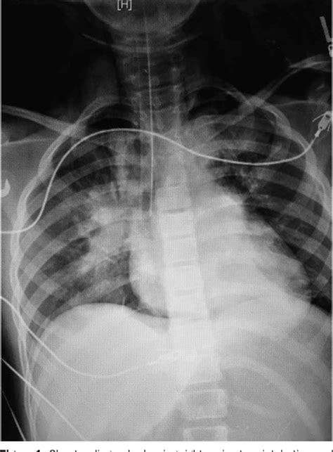 Figure 1 From Traumatic Tracheobronchial Laceration Causing Complete