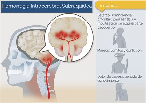 Hemorragia Intracerebral subraquídea Neurocirugía de la Torre