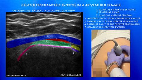 Ultrasound Of Greater Trochanteric Bursitis And Gluteal Tendons By Probeultrasound Youtube