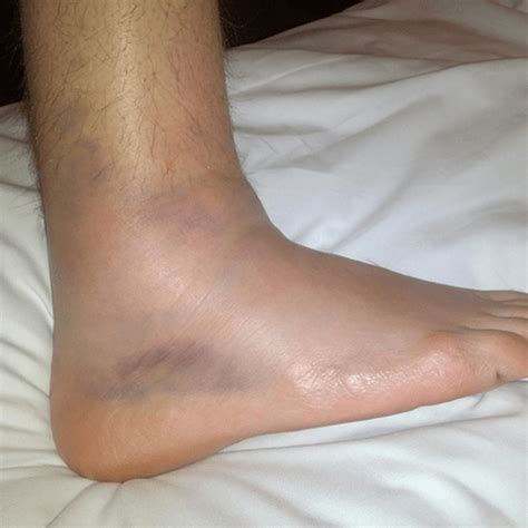 Image Gallery Swollen Ankles