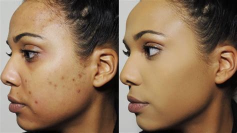 Get Rid Of Dark Spots On Face Causes Best Creams Home
