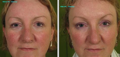 Photorejuvenation Ipl Pigment Before And After Gallery