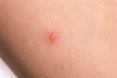 Diagnosing Skin Bumps Lumps Blisters Bug Bites