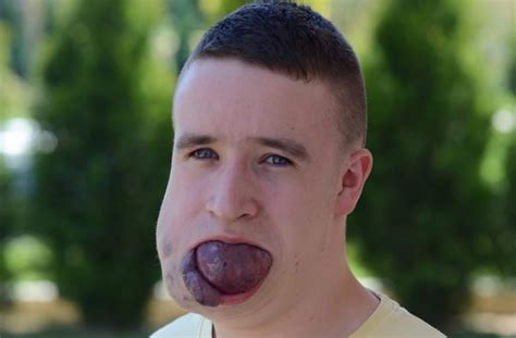 Man With Massive Tongue Tumor In Desperate Need Of Life Changing Operation