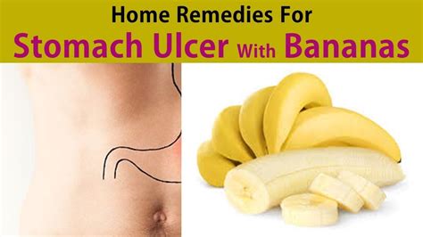 Home Remedies For A Stomach Ulcer Stop Ulcer With Bananas Youtube