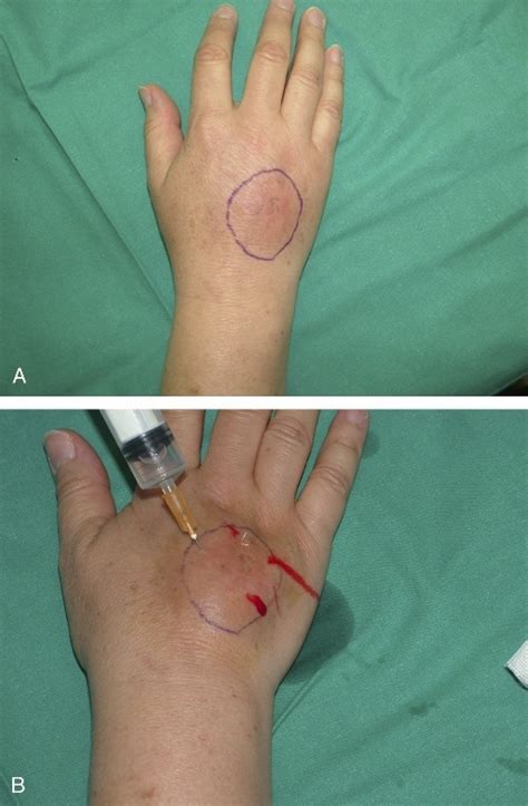 A Lesions Marked With A Dermographic Pencil B Illustration Of Saline