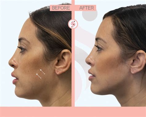 Restylane Filler Benefits Costs Results And Procedure Steps