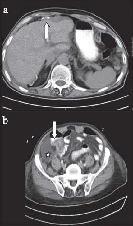 Axial Ct Scan Of The Abdomen And Pelvis With Oral And Iv Contrast A