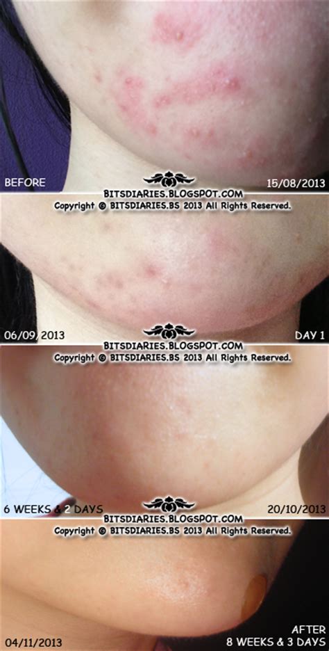 Chia bing xianghiruscar post acne's consumer. acne fashion: Review: Hiruscar Post Acne Gel