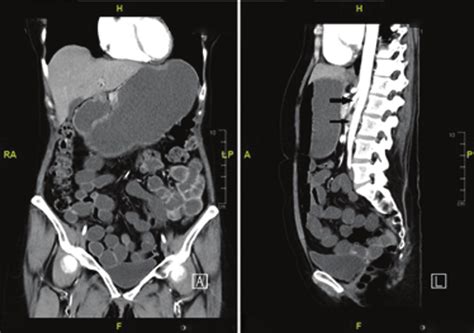 Contrast Enhanced Computed Tomography Scan Showing A Distended Stomach