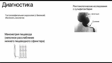 Ахалазия кардии. Заболевание нижнего пищеводного сфинктера. Факты о Картинка - Ахалазия кардии. Заболевание нижнего пищеводного сфинктера. Факты о
