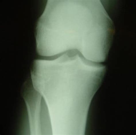 The Normal Knee X Ray What Are The Different Views