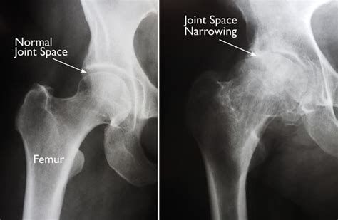 X Rays Of Normal Hip And Hip With Arthritis Total Hip Replacement