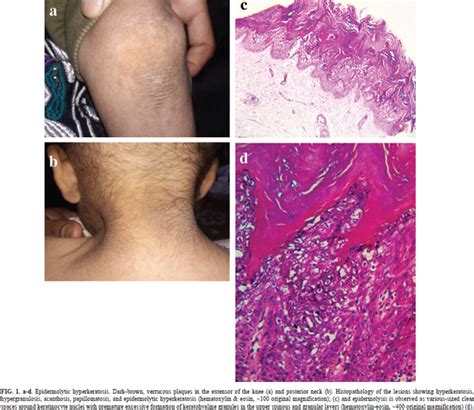 Epidermolytic Hyperkeratosis A Challenging Pathology For Clinical