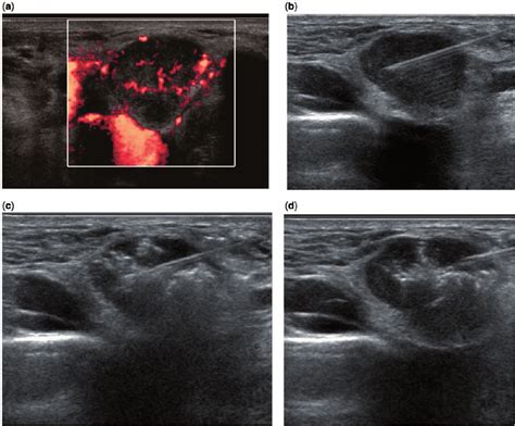How to perform basic thyroid ultrasound using point of care ultrasound. A) Power Doppler ultrasound shows a metastatic node from ...