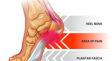 Whats The Difference Between Plantar Fasciitis And Heel Spurs