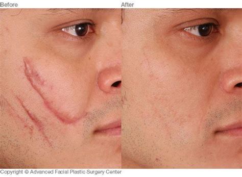 Scar Revision Before And After Photos Dr Benjamin Bassichis
