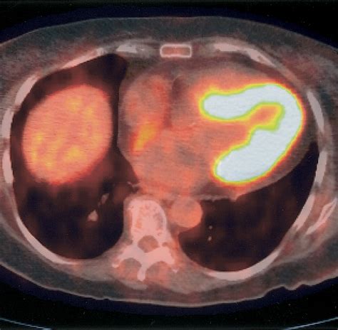 Pet Ct In Recurrent Ovarian Cancer Initial Observations Radiographics